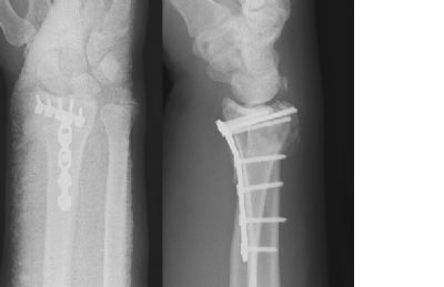 Radius, Distal:  Synthes Volar Plate (Implant 27)